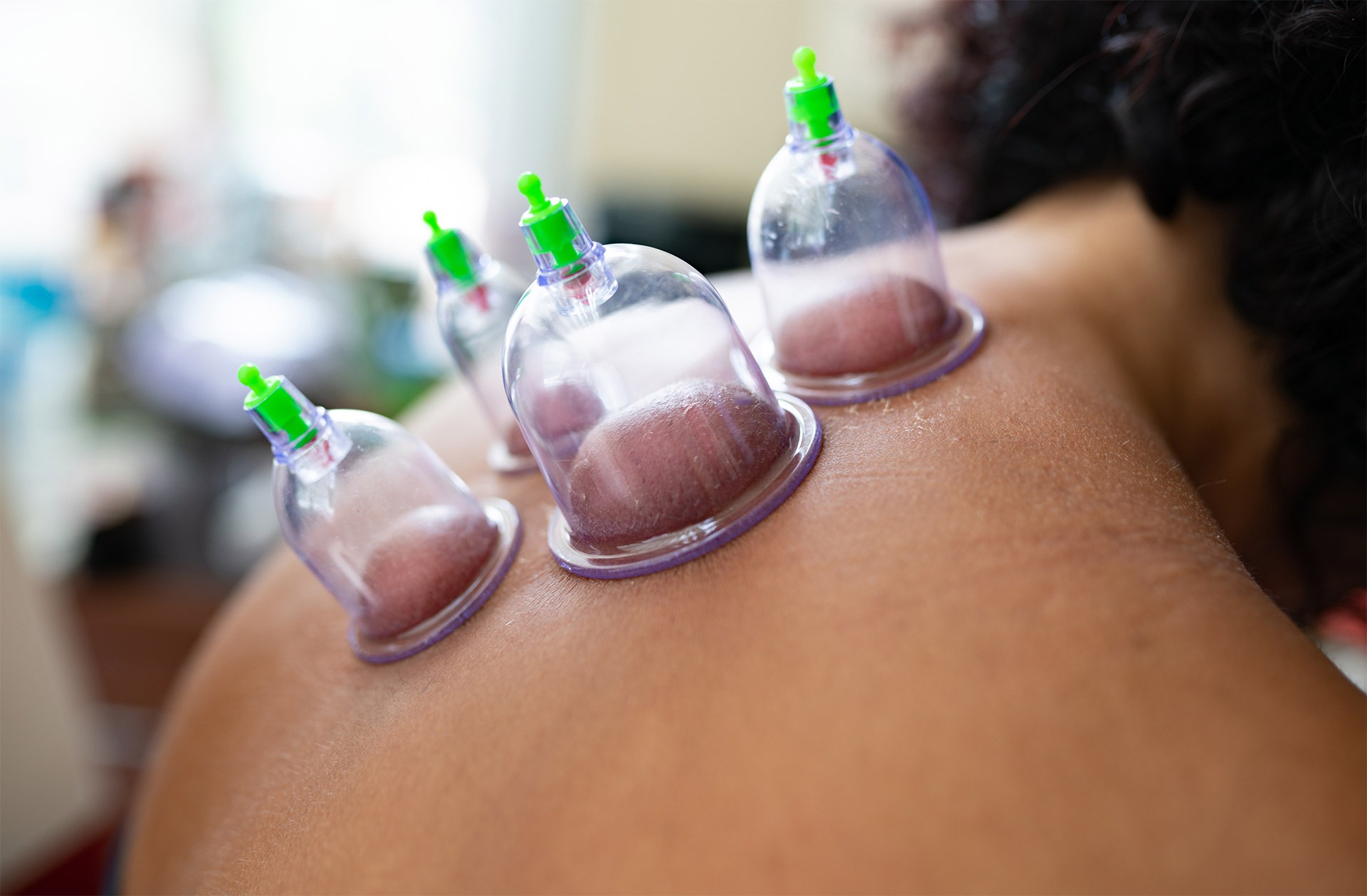 cupping