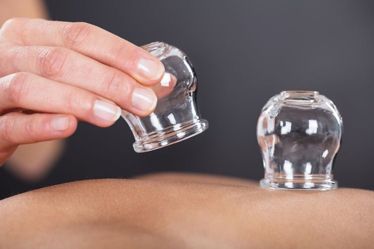 cupping