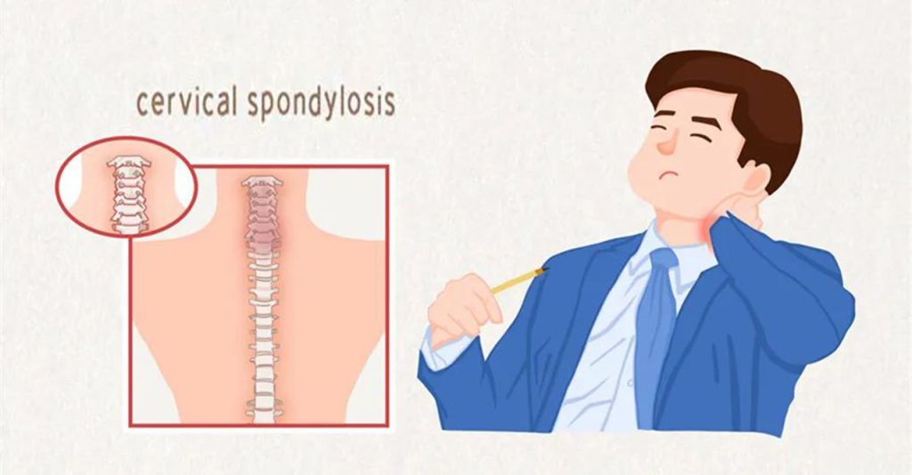 cervical spondylosis