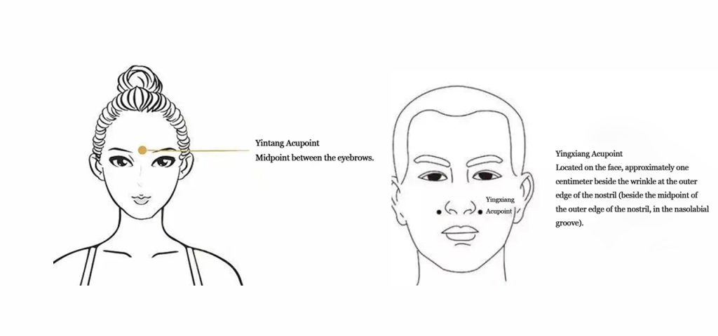 rhinitis moxibustion acupoints