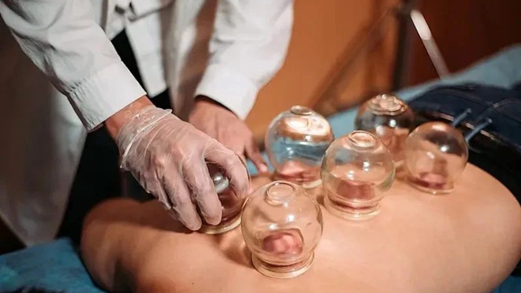 cupping