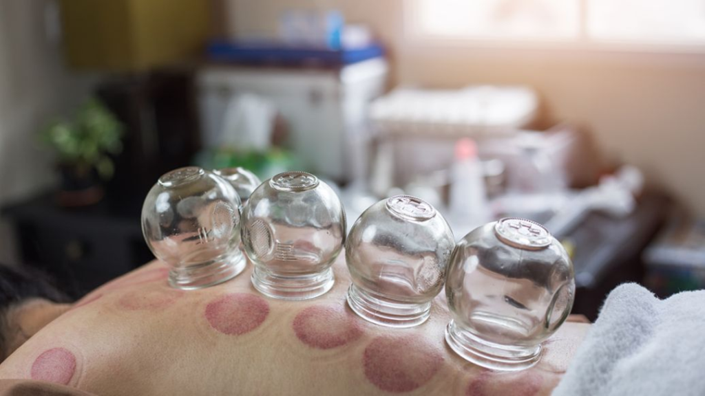 cupping