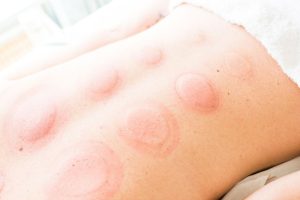 cupping marks1