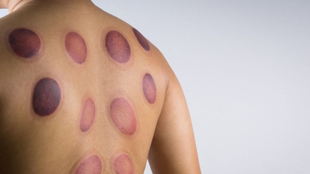 cupping marks2